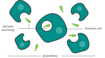 Ineffective immune cells gather around bacteria and fungi, forming granulomas.